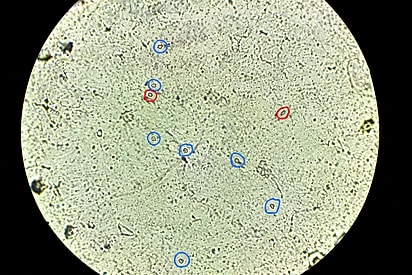 Imagem microscópica de uma amostra urinária Sedimento urinário de Kiss observado ao microscópio, com hemácias e leucócitos identificados na amostra.